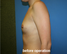 plastic-surgery-breast-augmentation